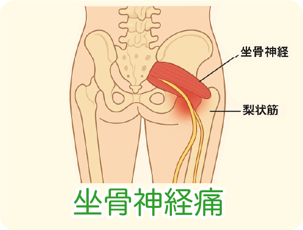 坐骨神経痛