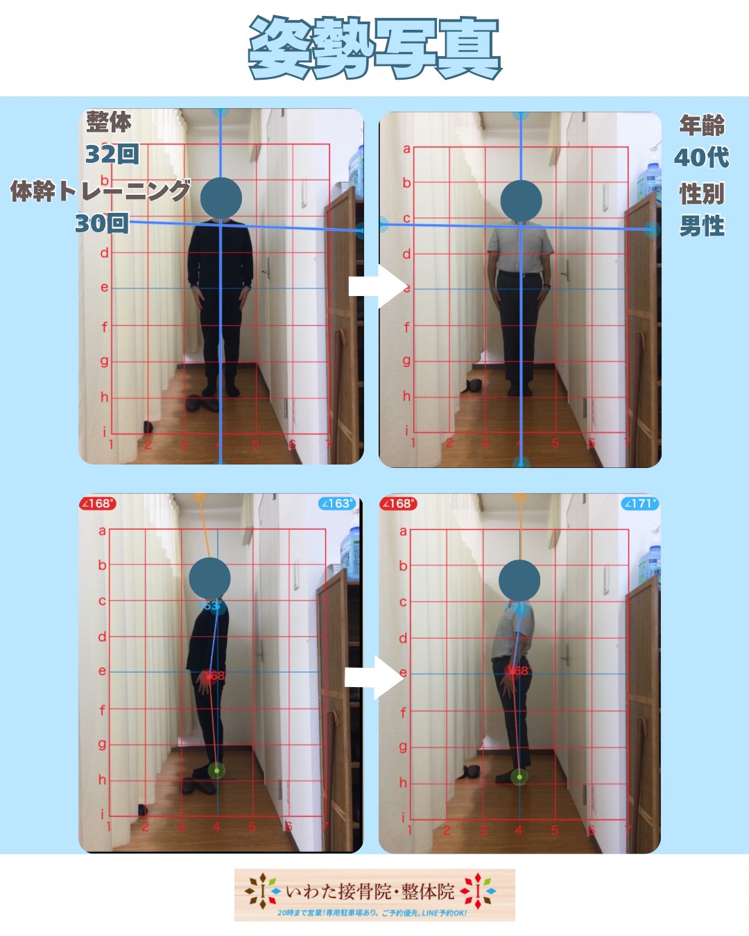 肩こり、頭痛の40代男性 整体32回・体幹トレーニング30回による姿勢改善前後の写真