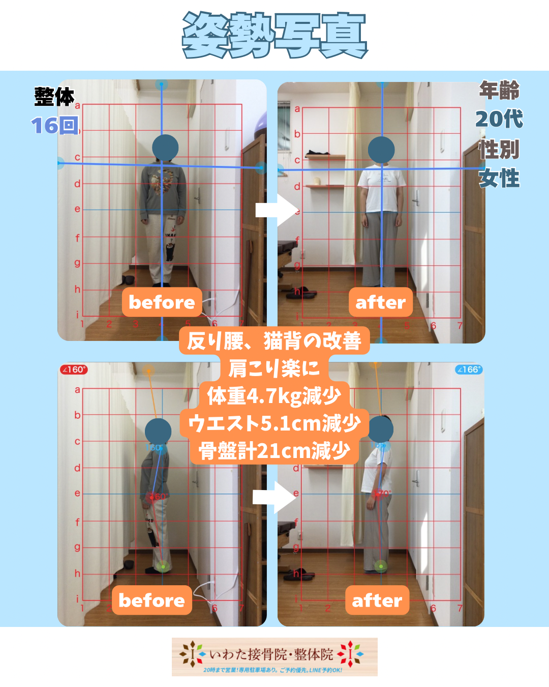 産後骨盤矯正　ダイエット　反り腰　整体